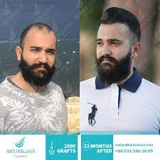 We are cheaper than uk or american clinics but our technology is the one of the most advanced in the world. Hair Transplant Results Natural Hair Turkey
