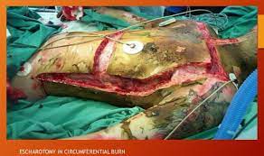 This burn educational video describes indications and technical aspects of escharotomy. Chest Escharotomy Prolongedfieldcare Org