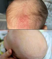 Image result for dry scabs on the head in children