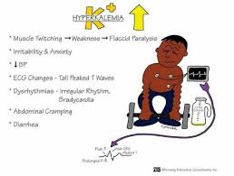 Patients with a relatively normal ecg can suffer sudden hyperkalaemia cardiac arrest. Hyperkalemia K 5 5 Peaked T Wave Usually The Earliest Sign Of Hyperkalemia K Hyperkalemia Nursing School Prerequisites Hyperkalemia Nursing