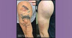 Enlighten is the newest addition to the laser tattoo removal market. Tattoo Removal Chula Vista Tattoo Removal