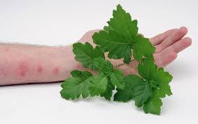 Image result for Rhus Dermatitis