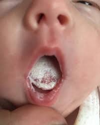 Image result for Puchýře na jazyku