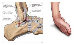 Pada video kali ini saya akan kongsikan rawatan awal bagi merawat kecederaan terseliuh buku lali (terseliuh kaki), ataupun kecederaan. Buku Lali Terseliuh Ankle Ez Physiotherapy Centre Facebook