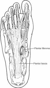 What cancerous tumors look and feel like. Plantar Fibroma Foot Health Facts