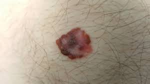 What signs or symptoms may make you suspect you may have skin cancer. Case Study 1 Flying Skin Cancer Doctor