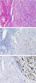 Tissues or organs via the bloodstream, the lymphatic system, or other means. Malignant Mesothelioma With Heterologous Elements Clinicopathological Correlation Of 27 Cases And Literature Review Modern Pathology