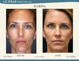 My body looks good with clothes i don't look flat flat like i do without clothes. 34 Sculptra Aesthetic Ideas Sculptra Aesthetic Sculptra Collagen Growth