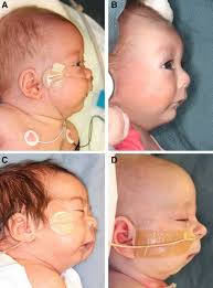 Image result for Micrognathia