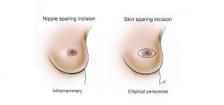 Image result for Mastectomy