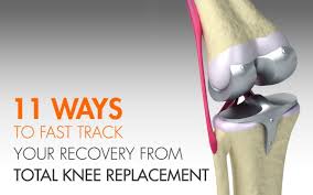 11 Ways To Fast Track Your Recovery From Total Knee Replacement Copperjoint Knee Replacement Surgery Recovery Total Knee Replacement Knee Replacement Exercises