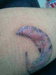 It appears that keloids can successfully be prevented and even reversed. Hypertrophic Scar Or Keloid Scar Photo