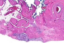 Old cells do not die and instead grow out of control, forming new, abnormal cells. Cancer Development Cancerquest