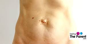 Umbilical Hernia After Pregnancy Causes Symptoms Non Surgical Treatments Being The Parent
