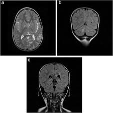 The mr signal is acquired at time te after excitation. Brain Mri T2 Weighted Images Tr Te 4000 99 Showed Pathologic Areas Download Scientific Diagram