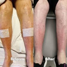 Image result for Lipodermatosclerosis