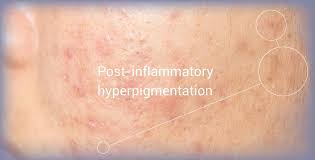 Image result for Postinflammatory Hyperpigmentation