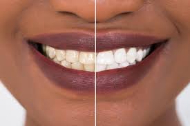 Image result for Teeth Whitening
