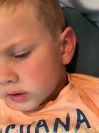 Could my child have Rocky Mountain Spotted Fever (RMSF) after a tick bite?