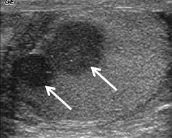 Biopsy of the tumor can determine if it is benign or malignant. Testicular Tumors What Radiologists Need To Know Differential Diagnosis Staging And Management Radiographics