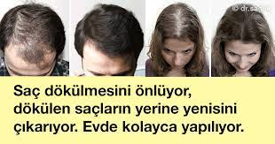 Sac Dokulmesi Genellikle Erkeklerle Iliskilendirilir Ama Aslinda Kadinlar Icin Gercekten Buyuk Bir Sorun Olabilir Istatistiklere Gore Hair Beauty Beauty Hair