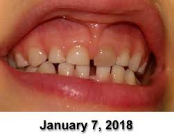 How To Naturally Heal Tooth Trauma The Naturally Minded Mother