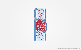 Unter einer thrombose versteht man eine lokalisierte, intravasale blutgerinnung, die zur bildung eines blutgerinnsels (thrombus) im kreislaufsystem führt. Thrombose Deutsche Gesellschaft Fur Phlebologie Dgp Venenheilkunde