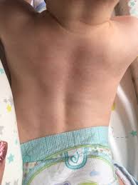 Image result for sweat rash on back baby