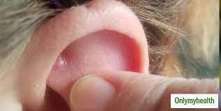 In this article, we will discuss what causes pimples in the ears and how to treat them. Dealing With A Pimple In Ear Here Are Some Home Remedies With Monsoon Skincare Quiz