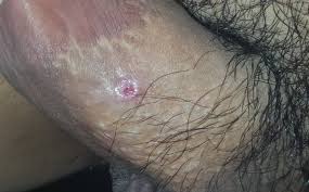 But if left untreated these infections can have a serious effect on a person's life. Has Penile Shaft Ulcer Skin Cancer Or Std Or Bacterial Infection Sexual Health Forums Patient