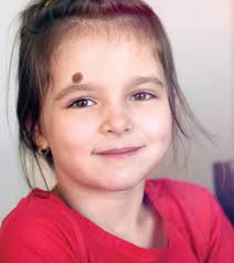 Having 5 or more sunburns doubles your risk for melanoma. New Melanoma And Nevus Clinic Opens St Louis Children S Hospital
