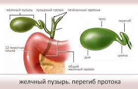 Peregib Zhelchnogo Puzyrya Simptomy I Lechenie Posledstviya