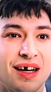 Why Did Flash Lose A Tooth