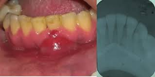 Image result for Periodontal Abscess