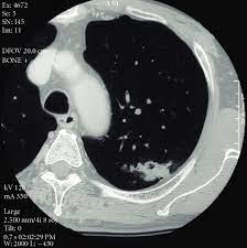 Various investigations are underway to reduce this disease. Ct Scanning Of Chest Showing A Lung Cancer Of 33 Mm In The Left S 1 2 Download Scientific Diagram