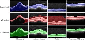 We did not find results for: Automatic Detection Of Retinal Regions Using Fully Convolutional Networks For Diagnosis Of Abnormal Maculae In Optical Coherence Tomography Images
