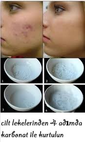 Completely Spotless Skin With 6 Effective Carbonate Mask Recipes Karbonat Cilt Ipuclari Sivilce Izi