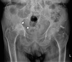 Image result for XRay Changes in Rheumatic Conditions