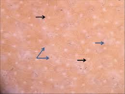 Folliculitis can affect any part of the body that has hair. Trichoscopy In Alopecias Diagnosis Simplified