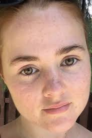 How long did you have purging after starting? Accutane Before And After 9 Women On Their Isotretinoin Side Effects