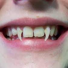 Vampire teeth is as simple as it's name sounds, fangs added onto our natural teeth that look like real vampire fangs. Vampire Teeth Warning Health24