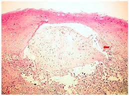 Symptoms include dysphagia, upper abdominal pain, diarrhea, nausea, vomiting, and sometimes hematemesis. Jcm Free Full Text Infectious Esophagitis In Romanian Children From Etiology And Risk Factors To Clinical Characteristics And Endoscopic Features