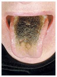 Image result for black tongue symptoms