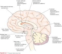 Keep a detailed record of your family's medical history, including cases of cancer and tumors. Primary Brain Tumors