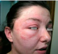 Image result for dermatitis contacta