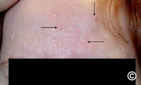 Image result for Sebaceous Gland
