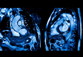 Image result for Cardiac MRI