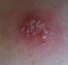 While many of the skin. Spider Bites Pictures Photos