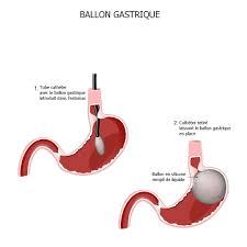 Voici les solutions de medisite et annie roques, diététicienne, pour réduire votre appétit et réussir à perdre du poids. Ballon Gastrique C Est Quoi Prix Imc Combien De Kilos Perdus