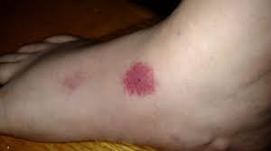 Image result for infected tick bite